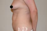 HR Plastic Surgery - Tummy Tuck patient before 2