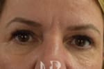HR Plastic Surgery - Eyelid Surgery (Blepharoplasty) patient after 2