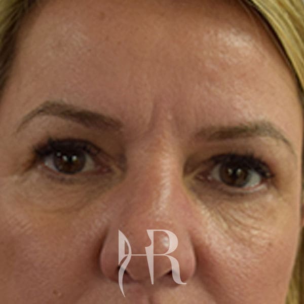 HR Plastic Surgery - Eyelid Surgery (Blepharoplasty) patient after 2