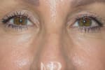HR Plastic Surgery - Eyelid Surgery (Blepharoplasty) patient after 4