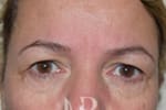 HR Plastic Surgery - Eyelid Surgery (Blepharoplasty) patient before 2