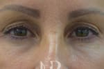 HR Plastic Surgery - Eyelid Surgery (Blepharoplasty) patient before 4