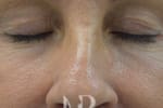 HR Plastic Surgery - Eyelid Surgery (Blepharoplasty) patient before 5