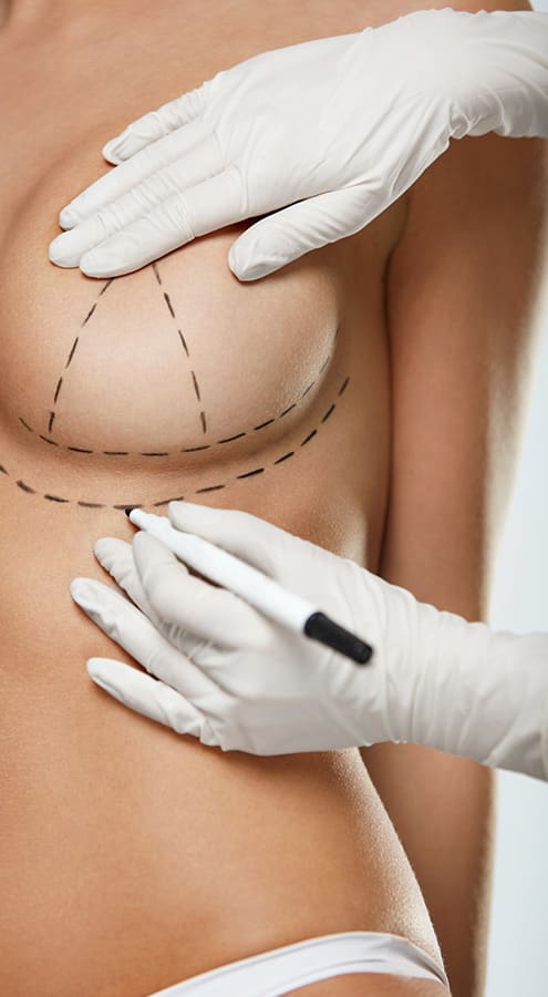 GalaFLEX breast lift