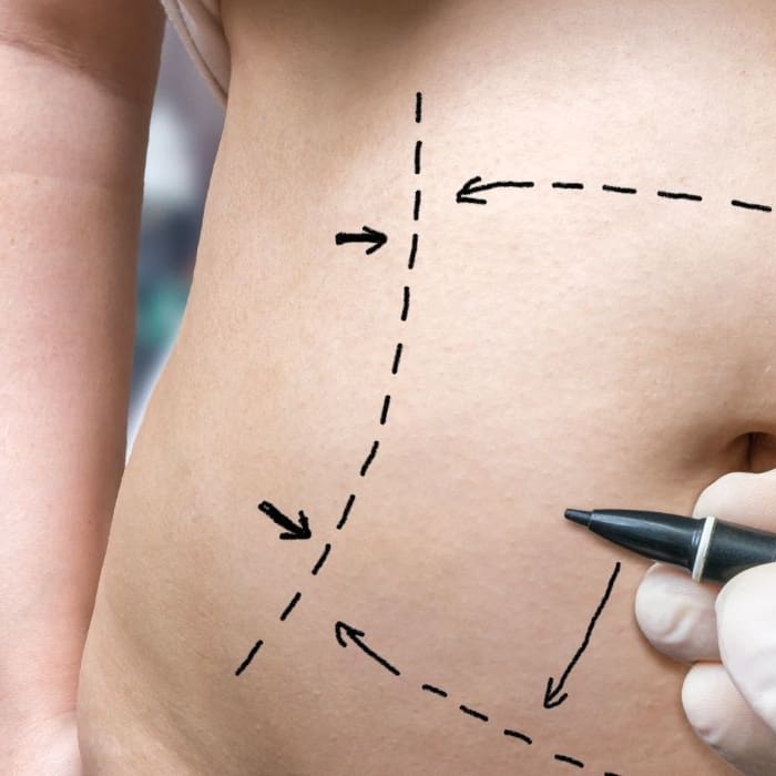 mummy makeover Surgery
