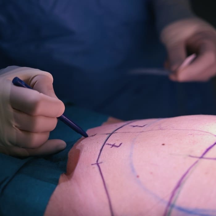tummy tuck in uk cost