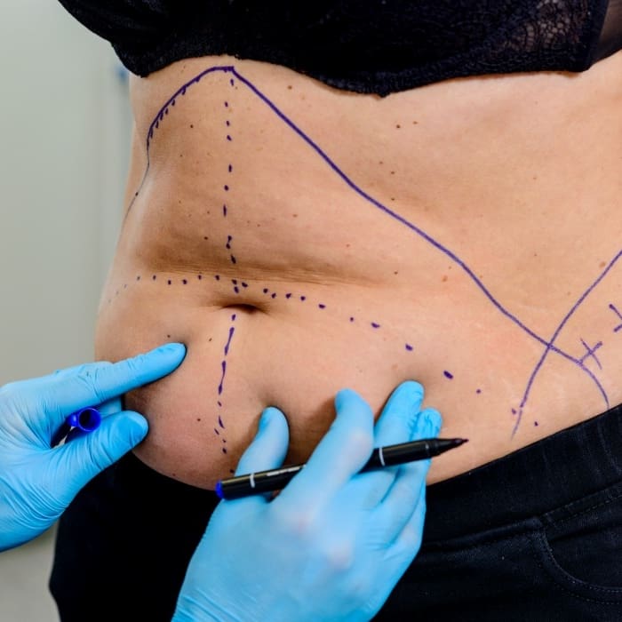 tummy tuck prices