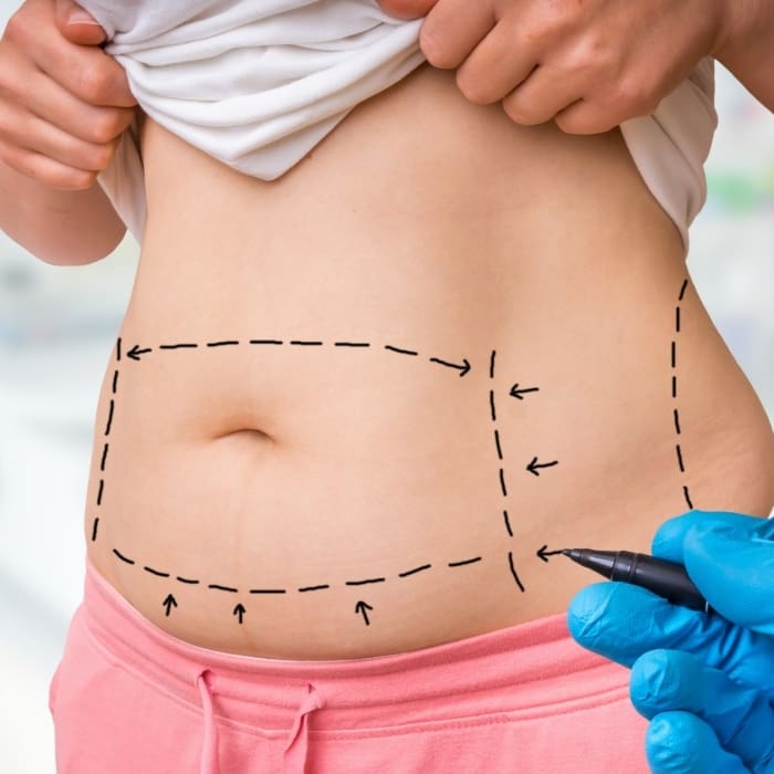 pricing tummy tucks