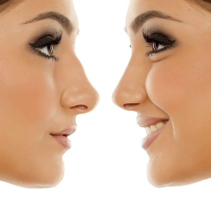 What Age Can You Get Rhinoplasty