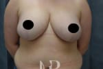 HR Plastic Surgery - Breast Reduction patient after 4