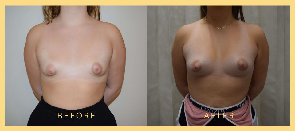 breast and nipple variations before after