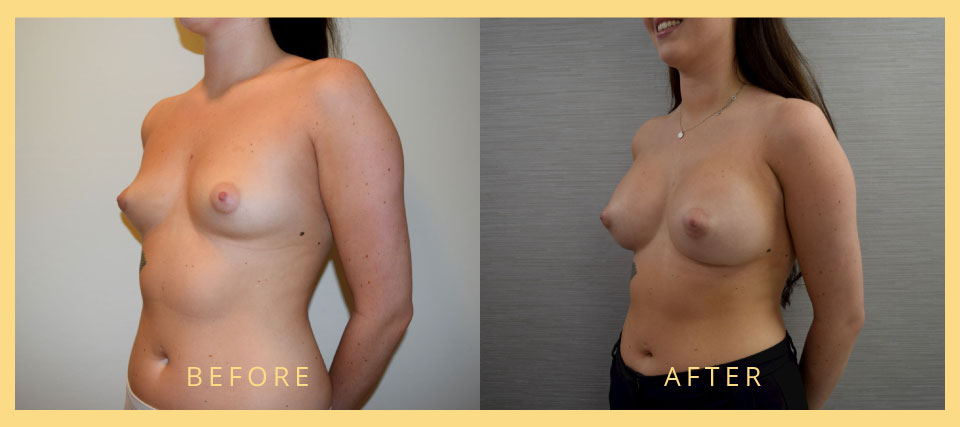 breast augmentation lift