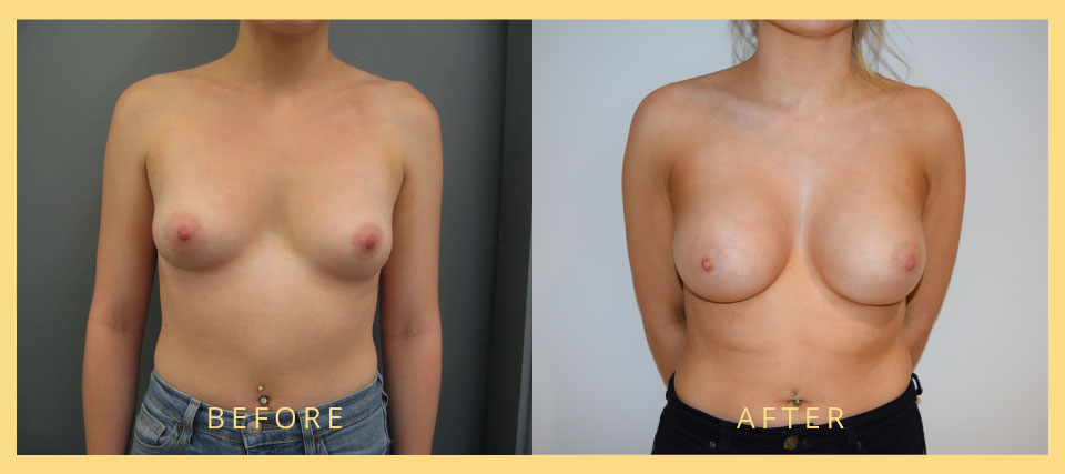 breast implant surgery london