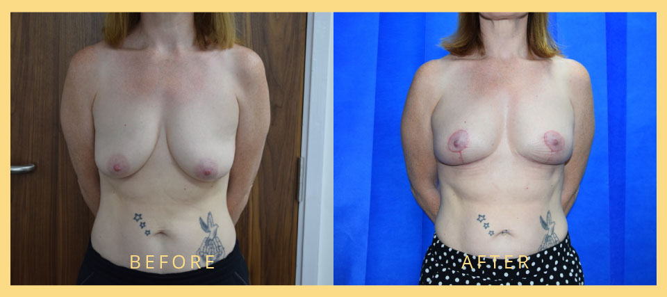 breast augmentation and lift