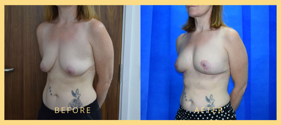 breast enlargement surgery london