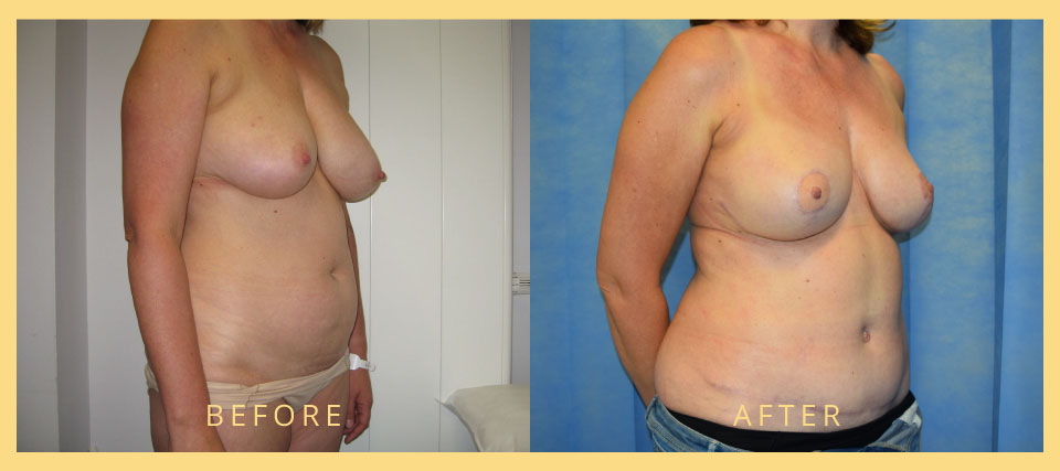 breast reconstruction before after