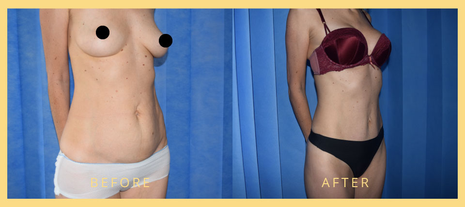 mini tummy tuck before after