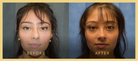 rhinoplasty before after