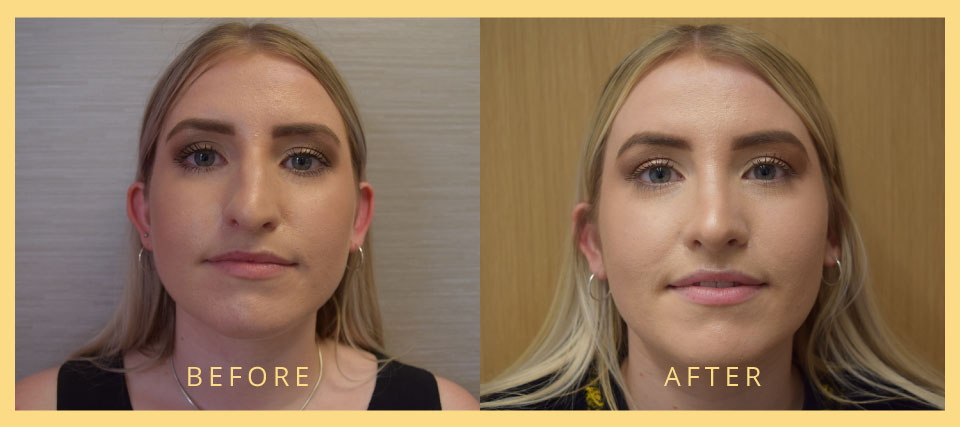 rhinoplasty london before and after