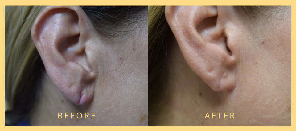 split earlobe repair before after