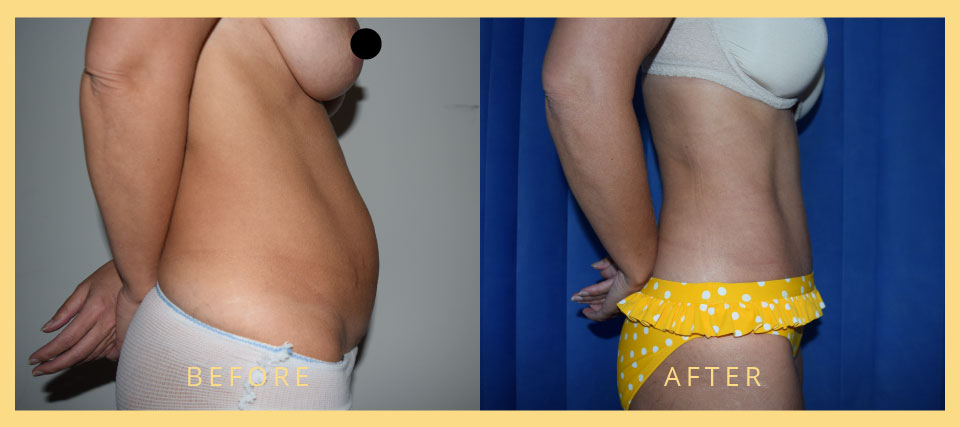 30 year old mother who was unhappy with the overhanging excess abdominal skin and the mild rectus abdominus divarication following her 2 pregnancies born through caesarean section. She underwent an abdominoplasty and lower divarication of rectus abdominus repair. Preoperative and 6 month postoperative photos showing a flat abdomen.